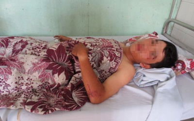 Cứu sống bệnh nhân vỡ bàng quang, xương chậu