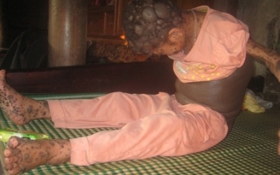 Xót xa bé gái bị mắc bệnh 'người thú'