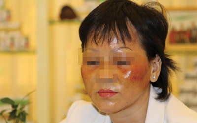 Nhập viện vì dùng phải mỹ phẩm giả