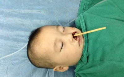 Đùa nghịch, bé trai 2 tuổi bị đũa chọc từ mũi lên não