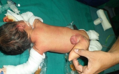 Cắt bỏ 'đuôi' khổng lồ cho bé trai 5 ngày tuổi