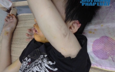 Bé trai bị hành hung đã qua cơn nguy kịch