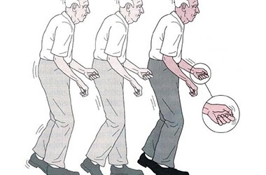 Tìm ra cơ chế gây tăng nặng của bệnh Parkinson