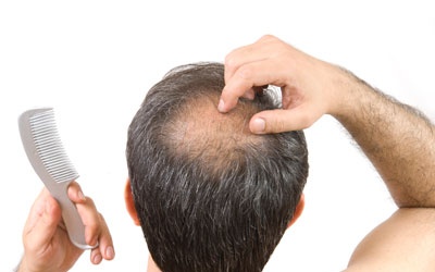 Nam giới hói đầu có nguy cơ cao bị ung thư tuyến tiền liệt