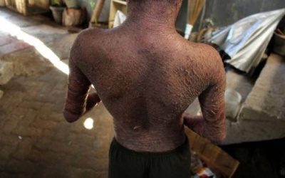 Lạ với cậu bé hai ngày thay da một lần