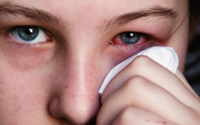 Đau mắt đỏ có thể bùng phát trên cả nước