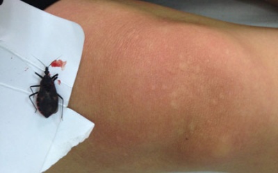 Hà Nội: Một bệnh nhân nhập viện do bọ xít hút máu cắn