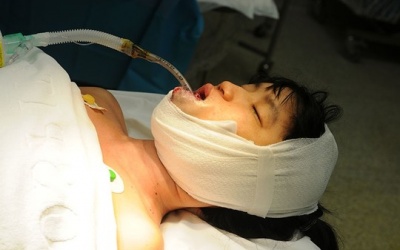 Phẫu thuật bóc khối u quái trong miệng bệnh nhân