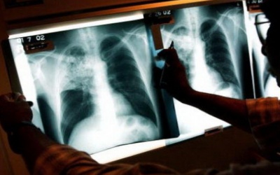 Nhân viên y tế lây bệnh lao cho nhiều trẻ nhỏ