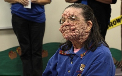 Cơ thể sần sùi, biến dạng vì bệnh lạ