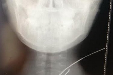 Cứu sống bệnh nhân bị cọng sắt bắn xuyên cổ
