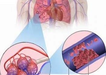 Cứu sống bệnh nhi không có động mạch phổi phải