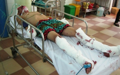 3 người nhập viện vì đài cassette phát nổ