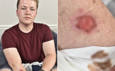 Bỏng cánh tay do iPhone 5