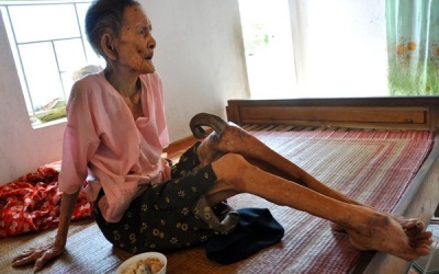 Cụ bà 97 tuổi mọc sừng 20cm