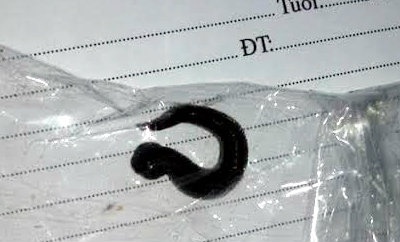 Kinh hãi đỉa sống trong thanh quản bệnh nhi