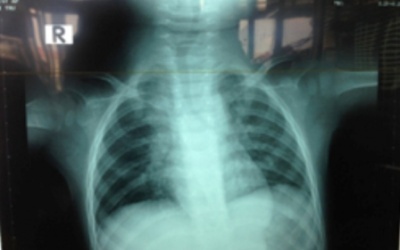 Trẻ nguy kịch vì hạt mãng cầu gây tắc phế quản