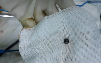 Suýt tử vong vì viên bi xe đạp