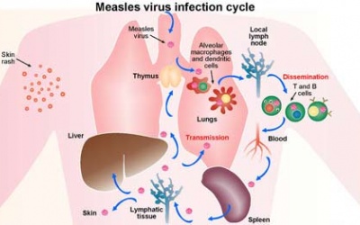 Tiêm vaccine là cách tốt nhất để phòng bệnh Sởi