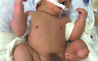  Bé sơ sinh mang dị tật bất thường