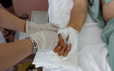 Suýt đứt lìa tay vì máy cưa