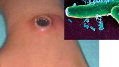 Ăn thịt gia súc chết, 9 người mắc phải bệnh than