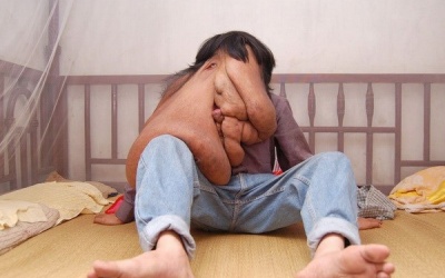 Cắt khối u 25 kg cho 'người đàn ông mặt voi' 