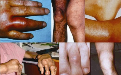 Cứng khớp – Dấu hiệu của “tàn phế”