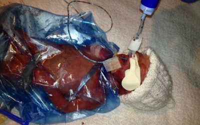 Sống sót kỳ diệu khi mới 23 tuần thai