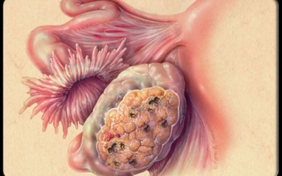 Băng vệ sinh giúp phát hiện ung thư buồng trứng