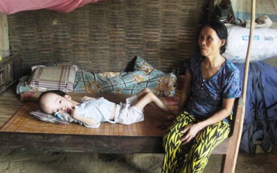  Đầu phình to hơn 20kg do bệnh u não