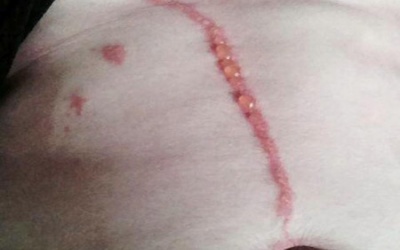 Kinh hãi nhện đào hang làm tổ dưới da