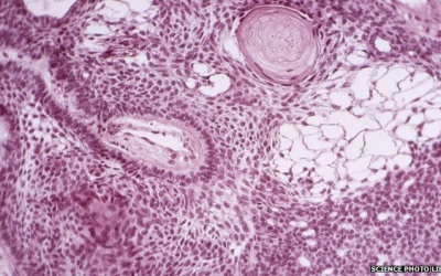 Ứng dụng tế bào gốc chữa ung thư não