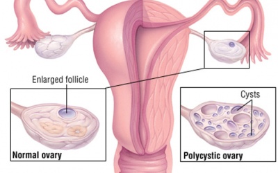 Đa nang buồng trứng có gây vô sinh? 