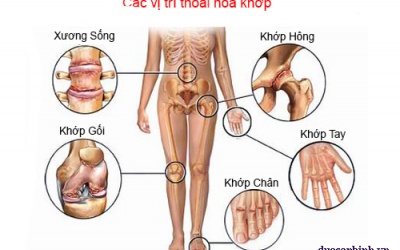 Chữa thoái hóa khớp bằng cách nào?