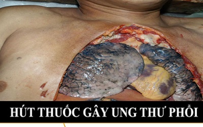 Bệnh do thuốc lá tiêu tốn 23.000 tỷ đồng mỗi năm