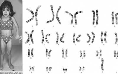 Không thể làm mẹ vì mắc hội chứng Turner