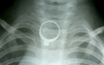 Bé 2 tuổi cấp cứu vì chơi với nhẫn vàng