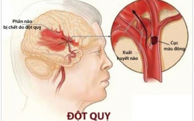 Cơn đột quỵ nhẹ – “thẻ vàng” cho sức khỏe