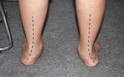 Điều trị tật bàn chân bẹt ở trẻ nhỏ