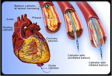 Cần làm gì sau khi đặt ống stent nong mạch vành?