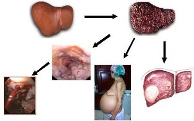 Phòng ngừa ung thư gan: Lời khuyên dành cho bạn