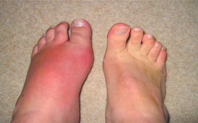 Gout không còn là 'độc quyền' của người giàu