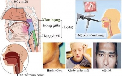 Ung thư vòm mũi họng: Hiểu đúng để phòng ngừa