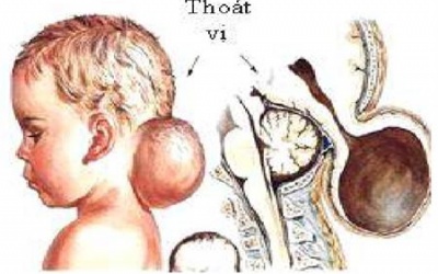 Thoát vị màng não tủy: Cần can thiệp sớm