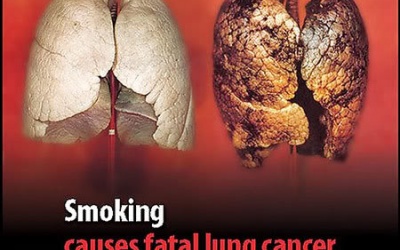 Mỗi năm 1,5 triệu người chết vì ung thư phổi