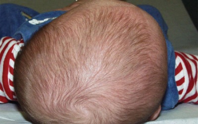 Phòng ngừa bẹt đầu sơ sinh không khó!