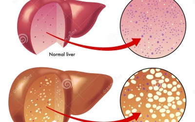 Gan nhiễm mỡ - Cần điều chỉnh lối sống