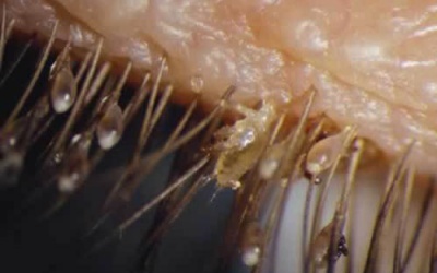 Rận mu 'tái xuất' tấn công người