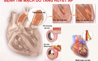Tăng huyết áp: Âm thầm mà nguy hiểm